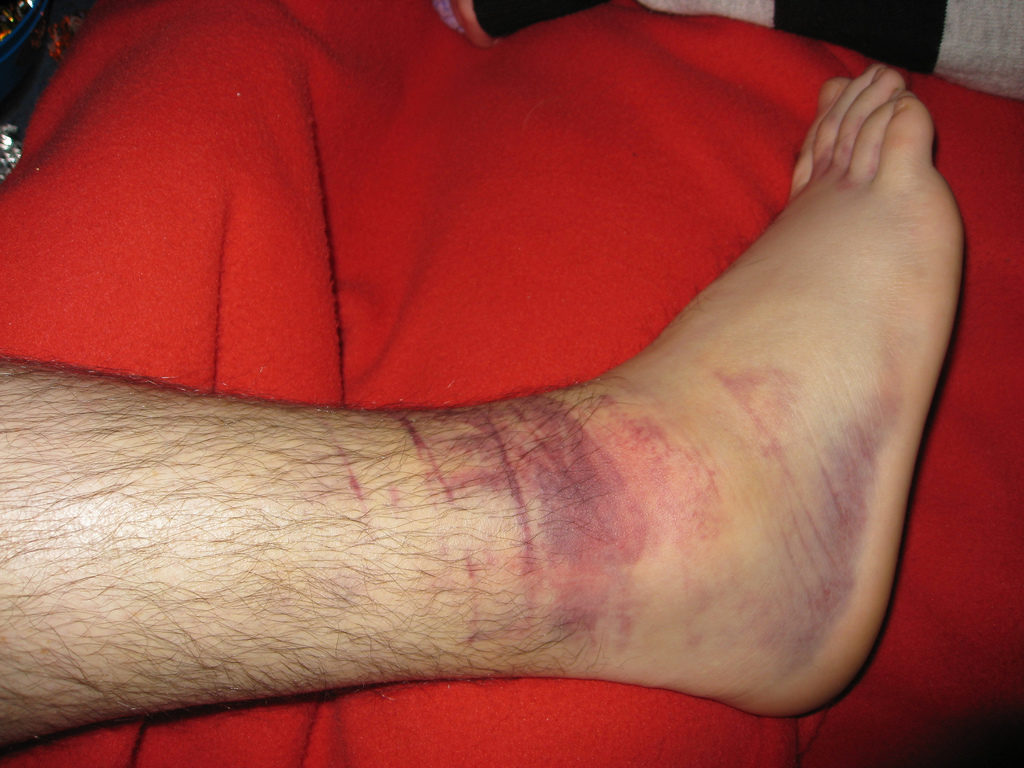 swolen edema ankle